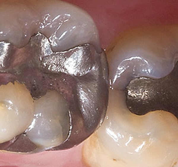با رعایت موارد زیر می توانید حساسیت دندان را کاهش دهید.